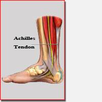 Achilles Tendonitis