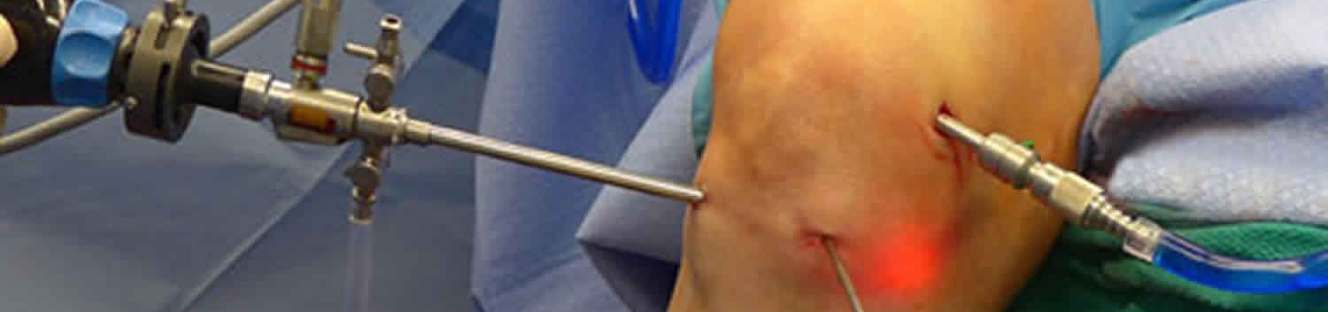 Knee Arthroscopy