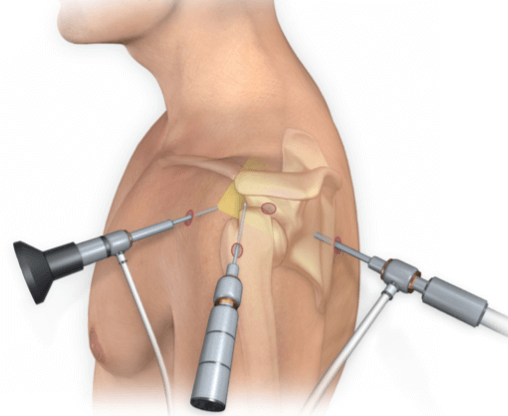 Shoulder Arthroscopy