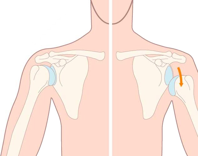 What Is Shoulder Subluxation Causes, Symptoms Treatment Options