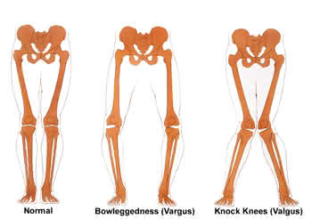 ossur unloader one knee brace
