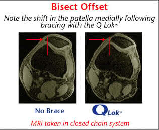 bioskin q lok knee brace patella alignment