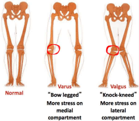 tossur formfit pro knee oa medial lateral
