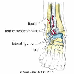 high ankle sprain injury anatomy